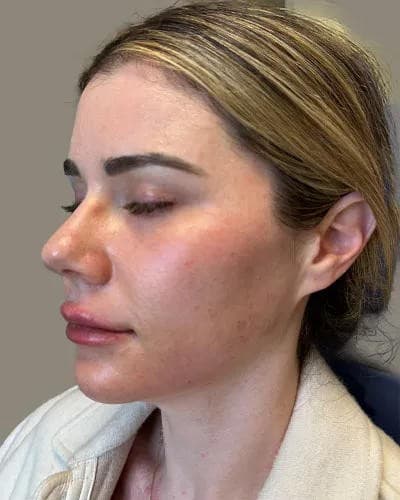 Laser Center of Marin Launches Bridal and Event Glow Package with Coordinated Dermaplaning